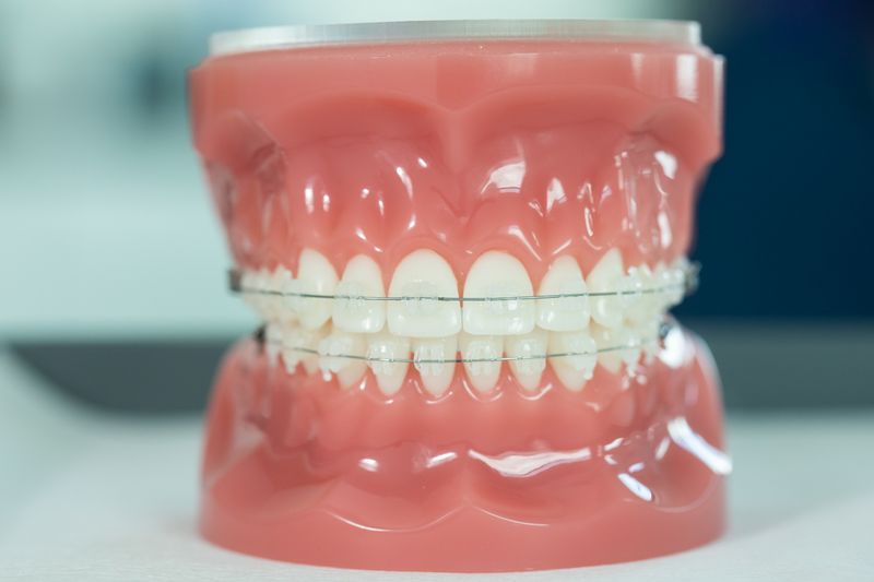 5 Most FAQs on Clear Braces